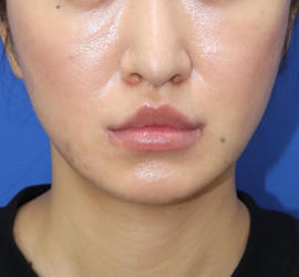 30代女性の唇・口元の整形 After 症例写真