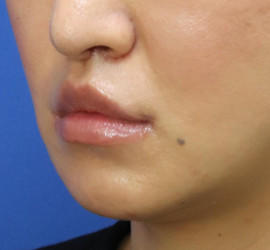 30代女性の人中短縮(リップリフト) After 症例写真