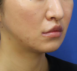 30代女性の人中短縮(リップリフト) After 症例写真