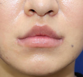 30代女性の人中短縮(リップリフト) After 症例写真