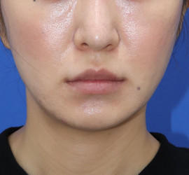 30代女性の唇・口元の整形 Before 症例写真