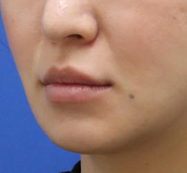 30代女性の人中短縮(リップリフト) Before 症例写真