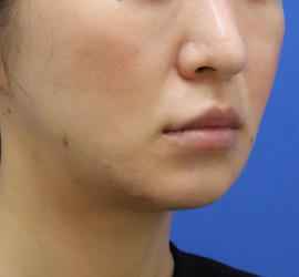 30代女性の人中短縮(リップリフト) Before 症例写真