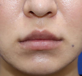 30代女性の人中短縮(リップリフト) Before 症例写真