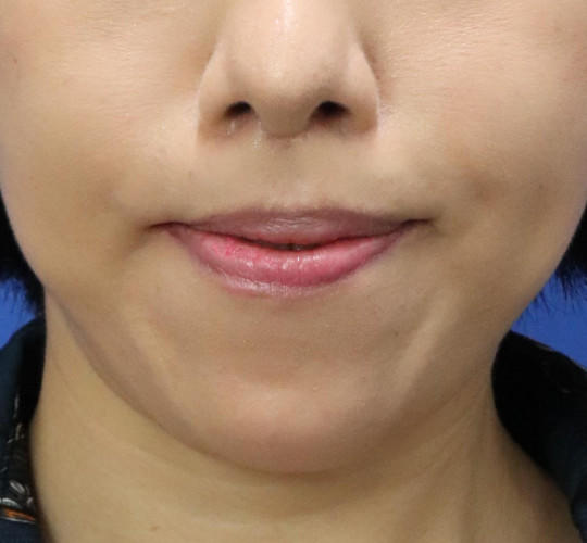 30代女性の唇・口元の整形 After 症例写真