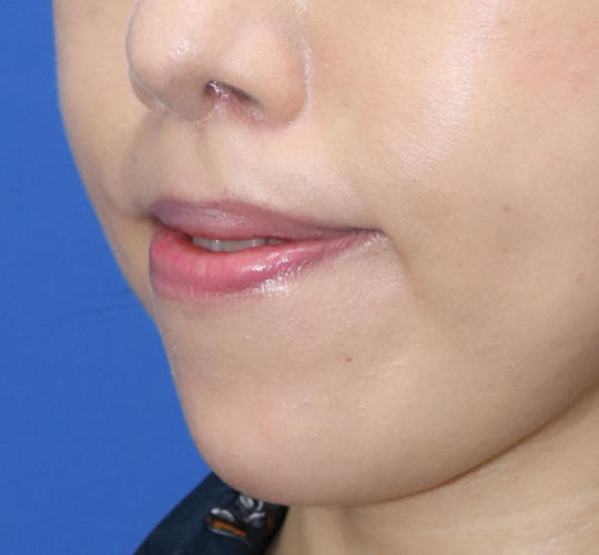 30代女性の人中短縮（リップリフト） After 症例写真