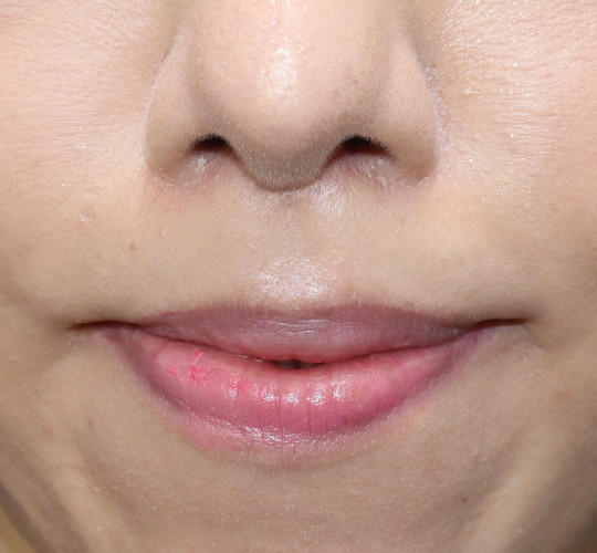 30代女性の人中短縮（リップリフト） After 症例写真