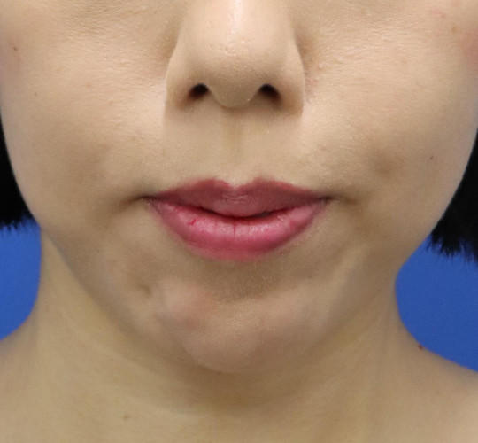 30代女性の唇・口元の整形 Before 症例写真