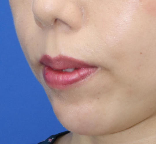 30代女性の人中短縮（リップリフト） Before 症例写真