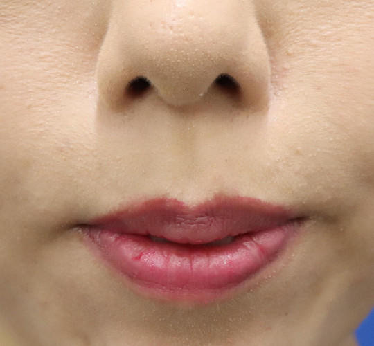 30代女性の人中短縮（リップリフト） Before 症例写真