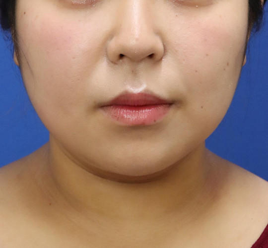 20代女性の顔の脂肪吸引 After 症例写真