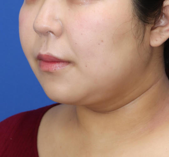 20代女性の顔の脂肪吸引  After 症例写真