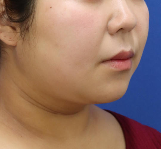 20代女性の顔の脂肪吸引  After 症例写真