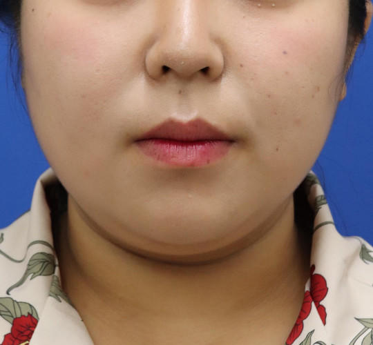 20代女性の顔の脂肪吸引 Before 症例写真