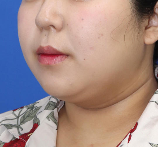 20代女性の顔の脂肪吸引  Before 症例写真