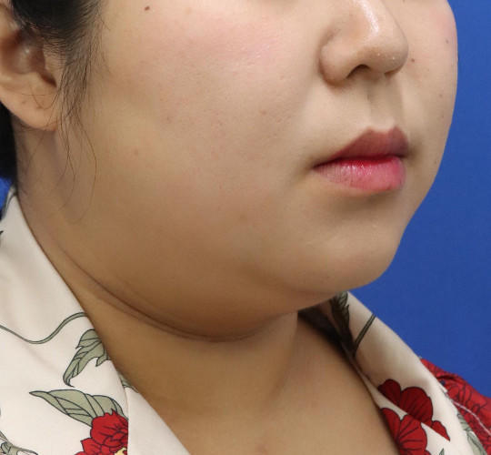 20代女性の顔の脂肪吸引  Before 症例写真