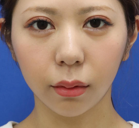 20代女性の唇・口元の整形 Before 症例写真