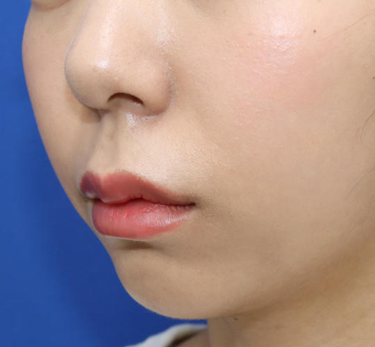 20代女性の人中短縮（リップリフト） Before 症例写真