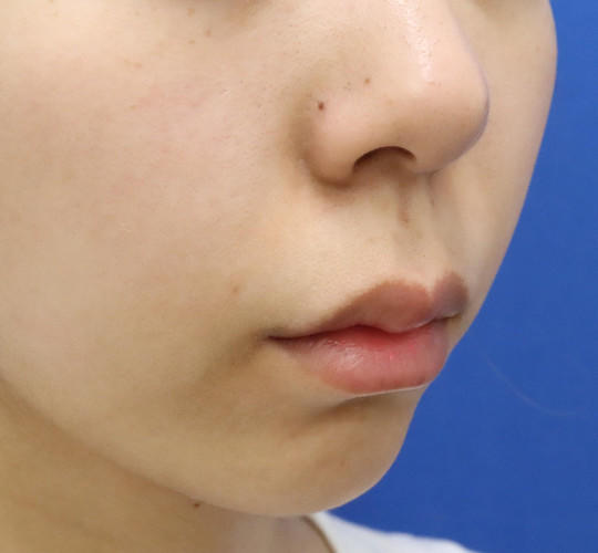 20代女性の人中短縮（リップリフト） Before 症例写真