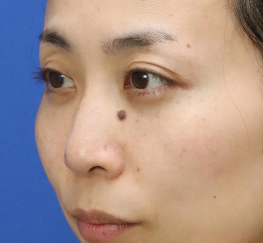 30代女性の3Dリポアイリフト  After 症例写真