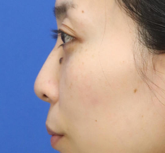 30代女性の3Dリポアイリフト  After 症例写真