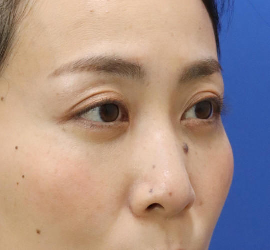 30代女性の3Dリポアイリフト  After 症例写真