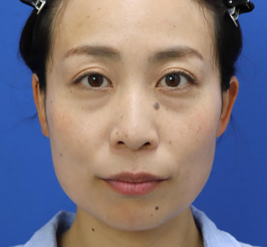 30代女性の目の下のクマ治療 Before 症例写真