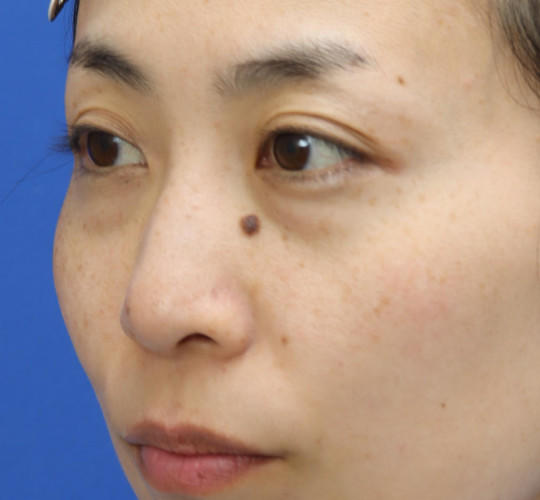 30代女性の3Dリポアイリフト  Before 症例写真