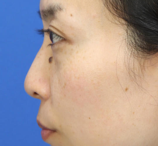 30代女性の3Dリポアイリフト  Before 症例写真