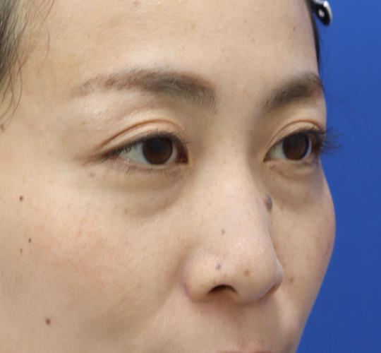 30代女性の3Dリポアイリフト  Before 症例写真