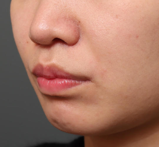 20代女性の人中短縮（リップリフト） After 症例写真