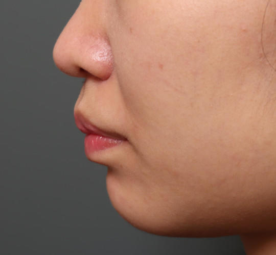 20代女性の人中短縮（リップリフト） After 症例写真