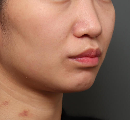 20代女性の人中短縮（リップリフト） After 症例写真