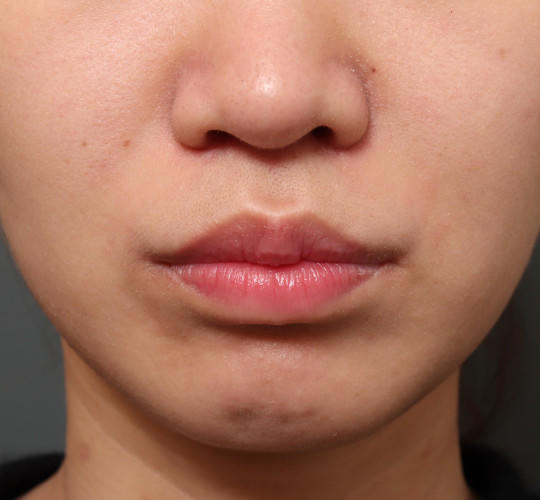 20代女性の鼻の整形 After 症例写真