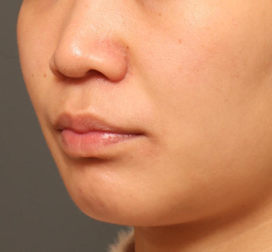 20代女性の人中短縮（リップリフト） Before 症例写真