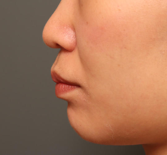 20代女性の人中短縮（リップリフト） Before 症例写真