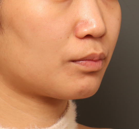 20代女性の人中短縮（リップリフト） Before 症例写真