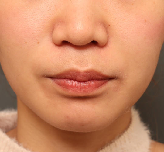 20代女性の鼻の整形 Before 症例写真