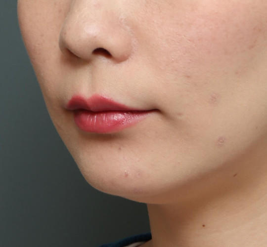 20代女性の人中短縮（リップリフト） Before 症例写真