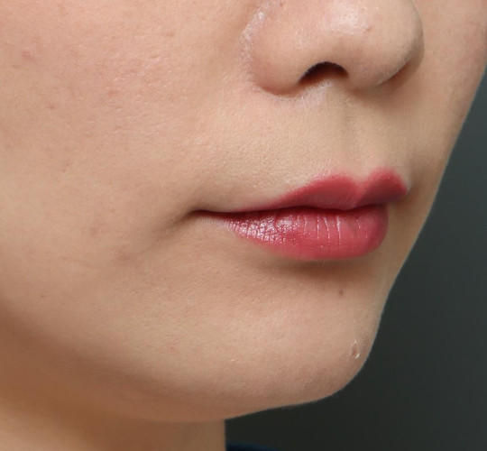 20代女性の人中短縮（リップリフト） Before 症例写真