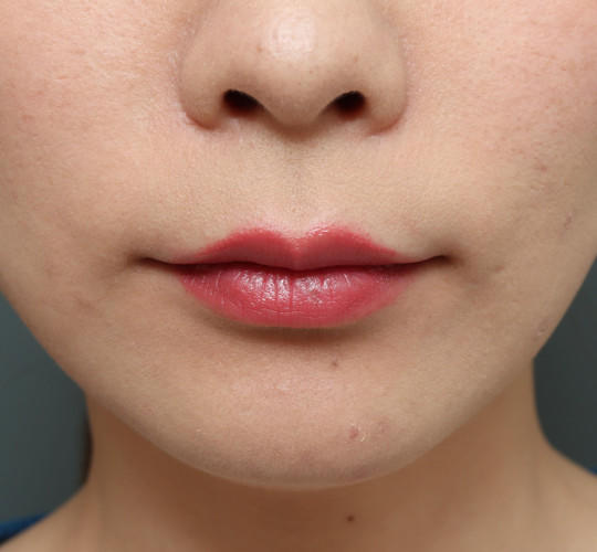 20代女性の人中短縮（リップリフト） Before 症例写真