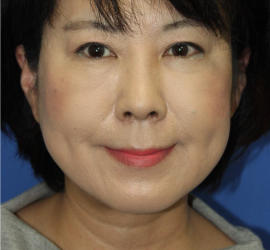 50代女性の肌再生高純度脂肪注入（脂肪移植） After 症例写真