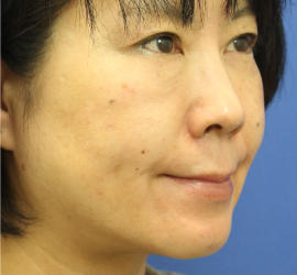 50代女性のシワ・たるみ After 症例写真