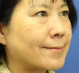 50代女性のシワ・たるみ Before 症例写真