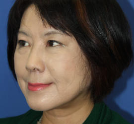 50代女性の肌再生高純度脂肪注入（脂肪移植） Before 症例写真