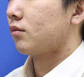 20代男性の小林式ニキビ治療法 After 症例写真