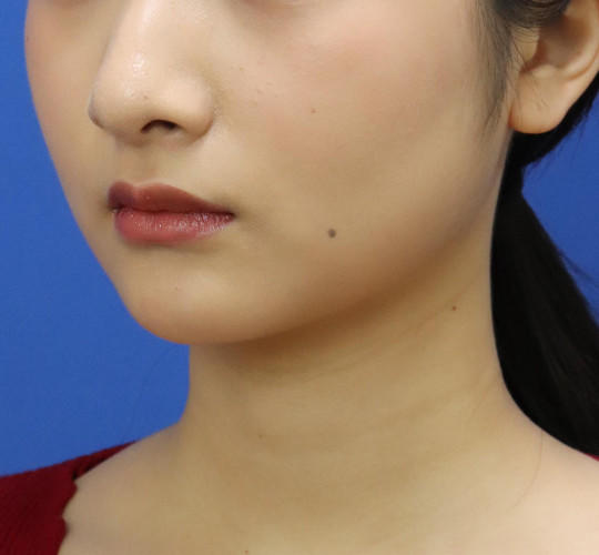 20代女性の顔の脂肪吸引 After 症例写真
