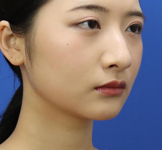 20代女性の顔の脂肪吸引  After 症例写真