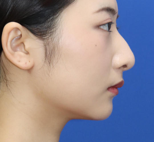 20代女性の顔の脂肪吸引  After 症例写真