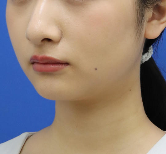 20代女性の顔の脂肪吸引 Before 症例写真
